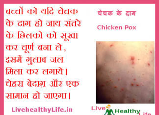 चेचक के दाग Chicken Pox