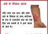 जले के निशान – Get rid of burn scars and marks get rid of burn scars marks
