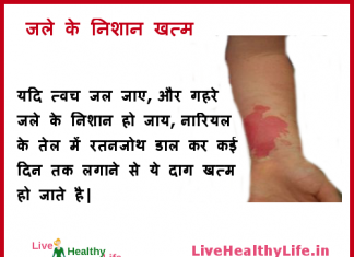 जले के निशान – Get rid of burn scars and marks get rid of burn scars marks