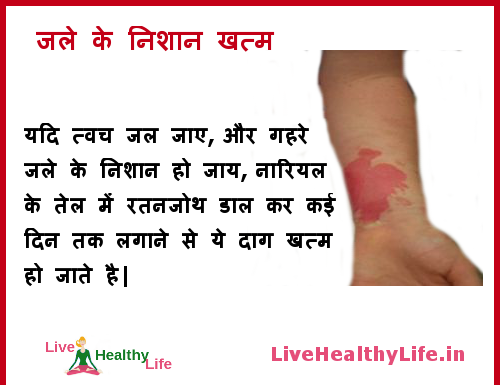 जले के निशान – Get rid of burn scars and marks get rid of burn scars marks