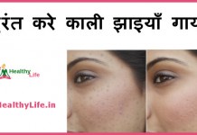 काली झाइयाँ – Black spots on face black spots on face