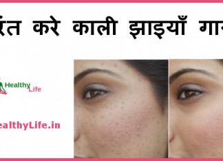 काली झाइयाँ – Black spots on face black spots on face