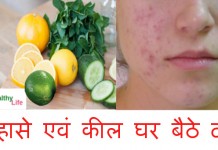 मुँहासे एवं कील घर बैठे दूर – How to get rid of Pimples fast how to get rid of pimples fast