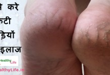 how to heal cracked feet