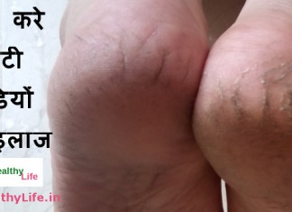 how to heal cracked feet