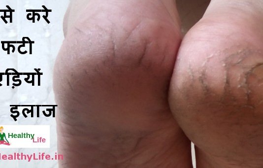 how to heal cracked feet