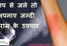 steam burn fast relief home remedies