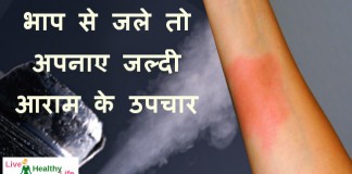 steam burn fast relief home remedies