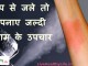 भाप से जले तो अपनाए जल्दी आराम के उपचार – Steam burn fast relief home remedies steam burn fast relief home remedies