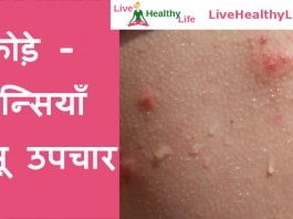 फोड़े - फुन्सियाँ घरेलू उपचार - Home Remedies for Boils - foda funsi