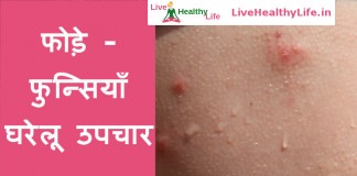 फोड़े - फुन्सियाँ घरेलू उपचार - Home Remedies for Boils - foda funsi