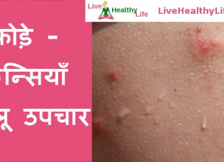 फोड़े - फुन्सियाँ घरेलू उपचार - Home Remedies for Boils - foda funsi