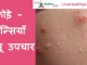 फोड़े – फुन्सियाँ घरेलू उपचार – Home Remedies for Boils – foda funsi फोड़े - फुन्सियाँ घरेलू उपचार - Home Remedies for Boils - foda funsi