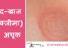 दाद और खुजली (एक्जीमा) का घरेलु उपचार  – Ring worm and eczema home remedy Ring worm and eczema home remedy