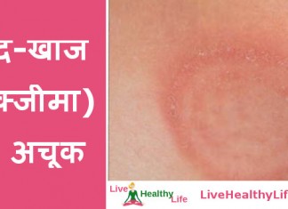 Ring worm and eczema home remedy