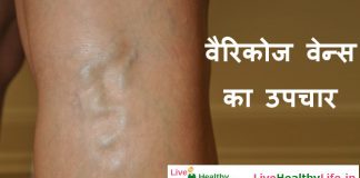 वैरिकोज वेन्स का उपचार Varicose Veins treatment