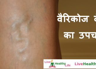 वैरिकोज वेन्स का उपचार Varicose Veins treatment वैरिकोज वेन्स का उपचार Varicose Veins treatment