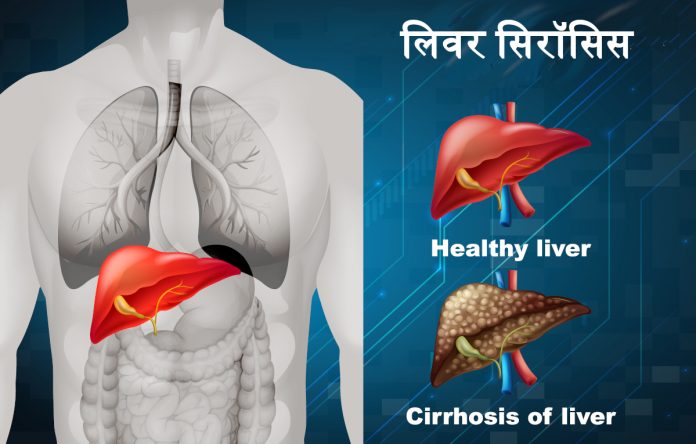 liver-cirrhosis