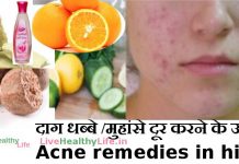 remove acne