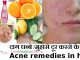 चेहरे पर काले दाग धब्बे | चेहरे पर मुंहासे दूर करने के उपाय  – Acne remedies in Hindi remove acne